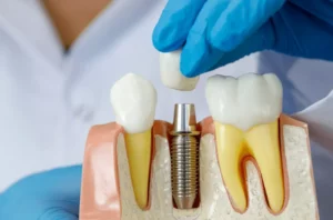 Dental Implants by Dr. Frank Hackman DDS 